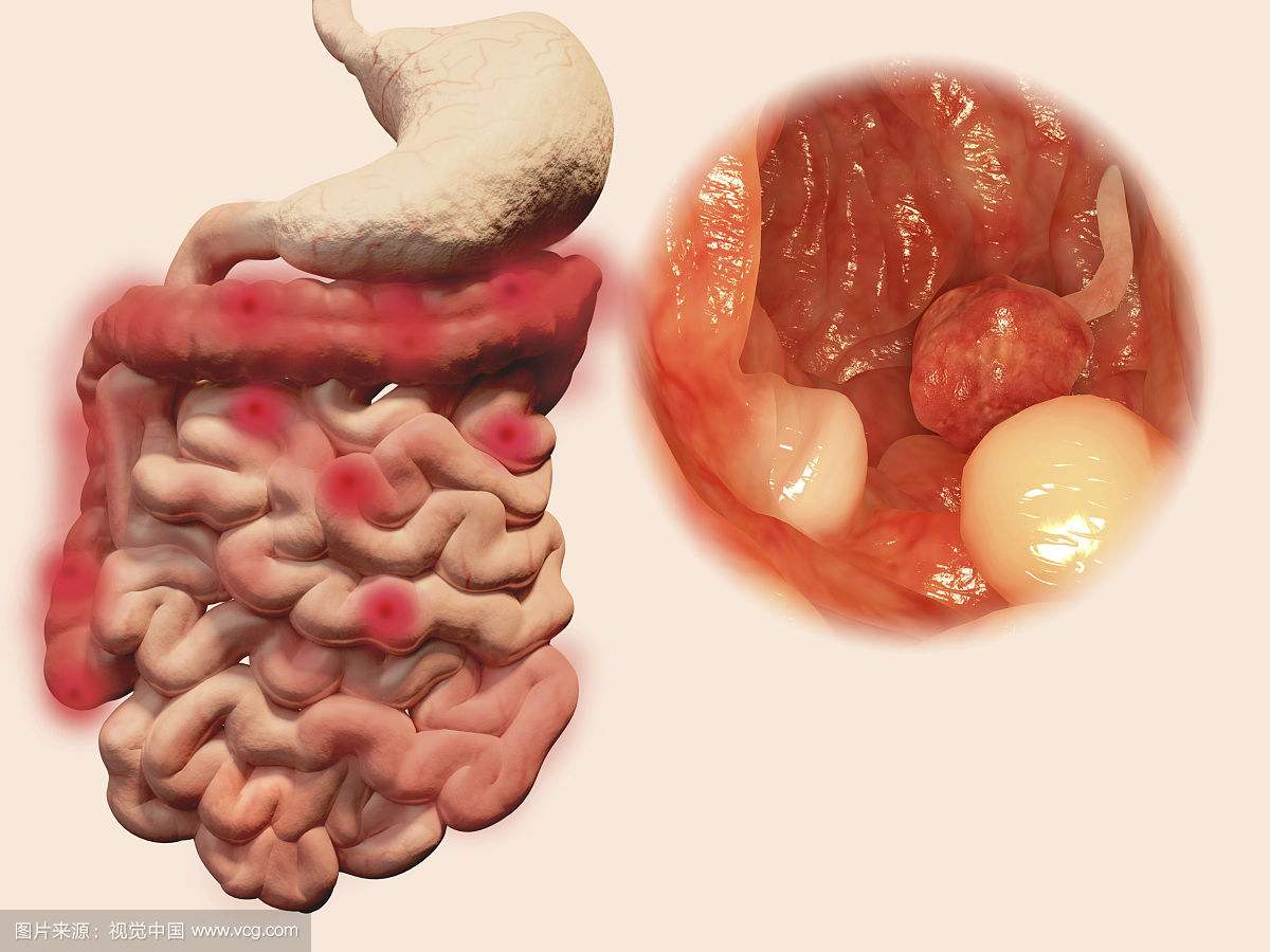 南寧腸道息肉怎么發(fā)現和治療