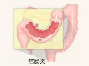南寧治療結腸炎醫院哪家好