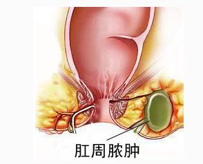 南寧哪個(gè)醫院治療肛周膿腫好