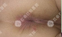 治療痔瘡去南寧哪家醫院好呢?