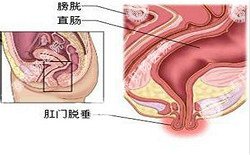 南寧治療脫肛哪家醫院好？南寧脫肛治療多少錢(qián)？